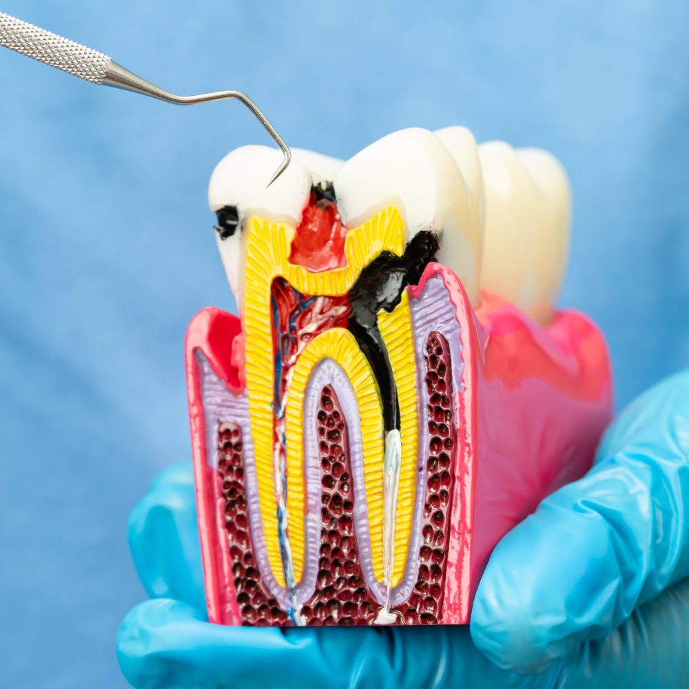 Asian dentist holding dental implant, artificial tooth roots into jaw, root canal of dental treatment, gum disease, teeth model for dentist.